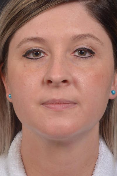 Neck Liposuction Before & After Gallery - Patient 427045 - Image 2