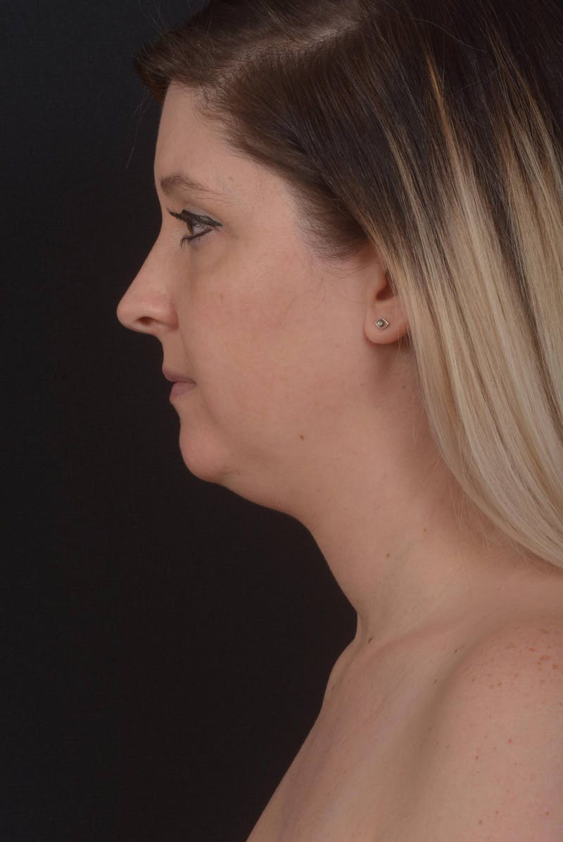 Neck Liposuction Before & After Gallery - Patient 427045 - Image 3