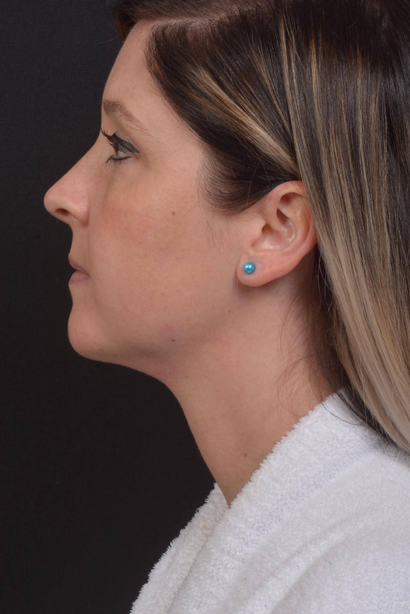 Neck Liposuction Before & After Gallery - Patient 427045 - Image 4
