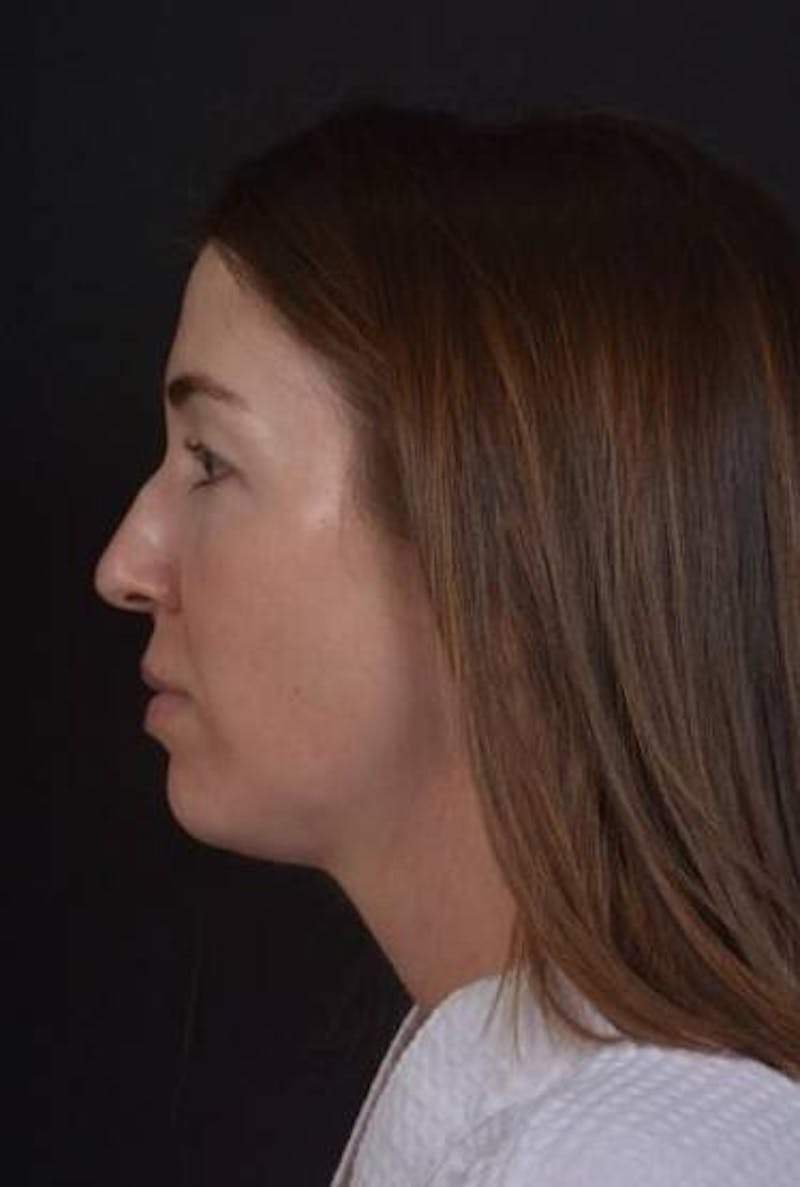 Neck Liposuction Before & After Gallery - Patient 269153 - Image 5