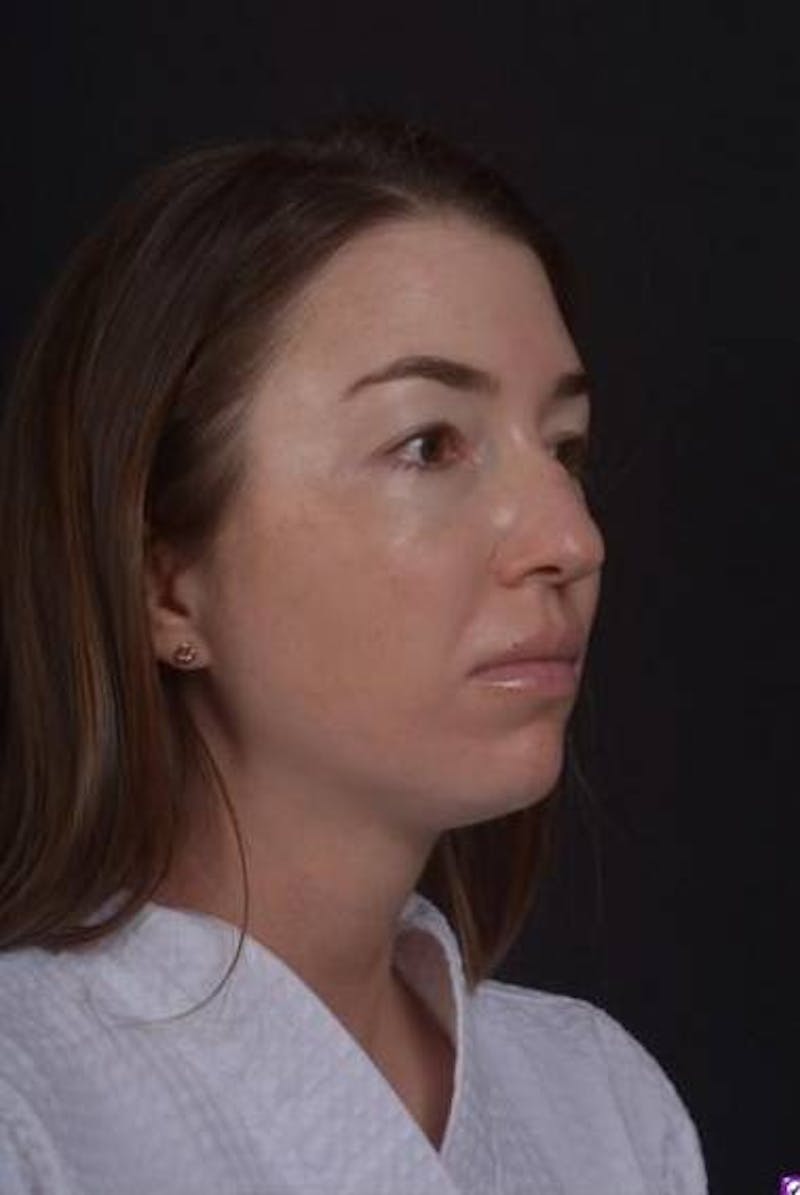 Neck Liposuction Before & After Gallery - Patient 269153 - Image 7
