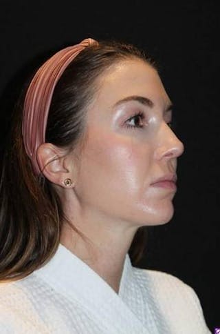 Neck Liposuction Before & After Gallery - Patient 269153 - Image 8
