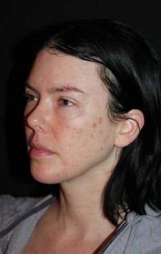 Browlift Before & After Gallery - Patient 396351 - Image 4