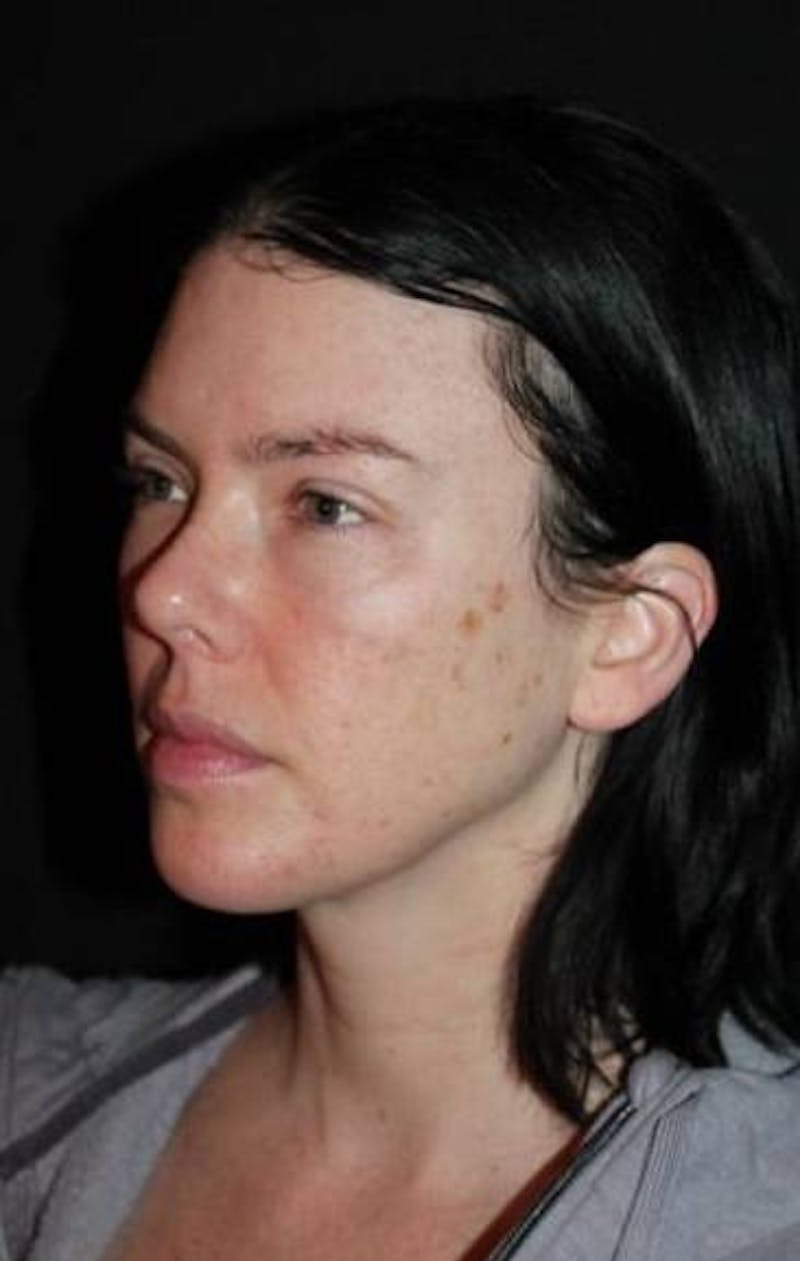 Blepharoplasty Before & After Gallery - Patient 704819 - Image 4