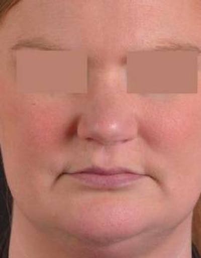 Neck Liposuction Before & After Gallery - Patient 366338 - Image 1