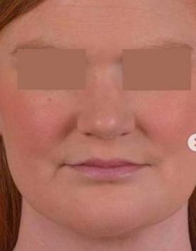 Neck Liposuction Before & After Gallery - Patient 366338 - Image 2