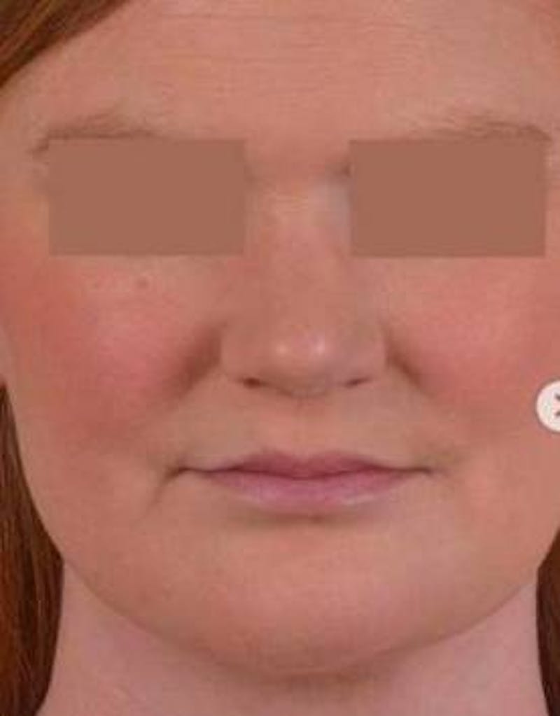 Neck Liposuction Before & After Gallery - Patient 366338 - Image 2