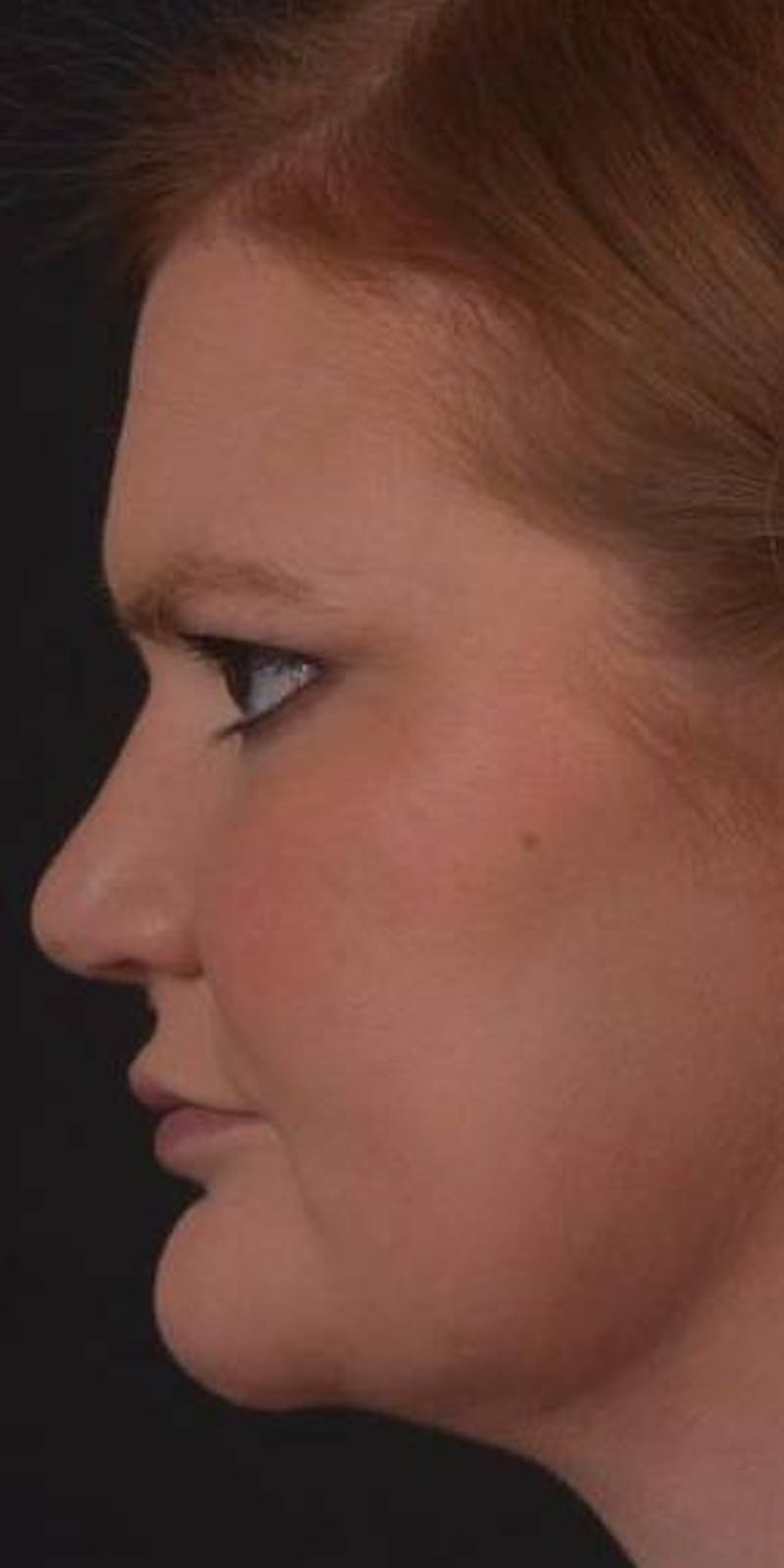 Neck Liposuction Before & After Gallery - Patient 366338 - Image 4