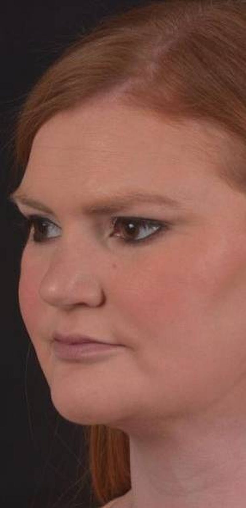 Neck Liposuction Before & After Gallery - Patient 366338 - Image 6
