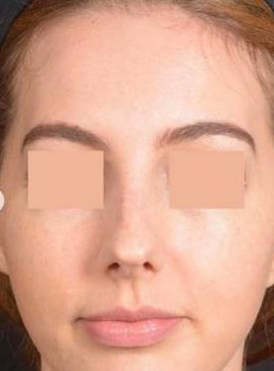 Rhinoplasty Before & After Gallery - Patient 338088 - Image 1