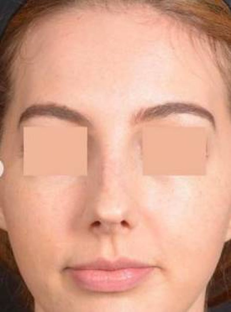 Rhinoplasty Before & After Gallery - Patient 338088 - Image 1