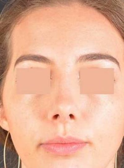 Rhinoplasty Before & After Gallery - Patient 338088 - Image 2