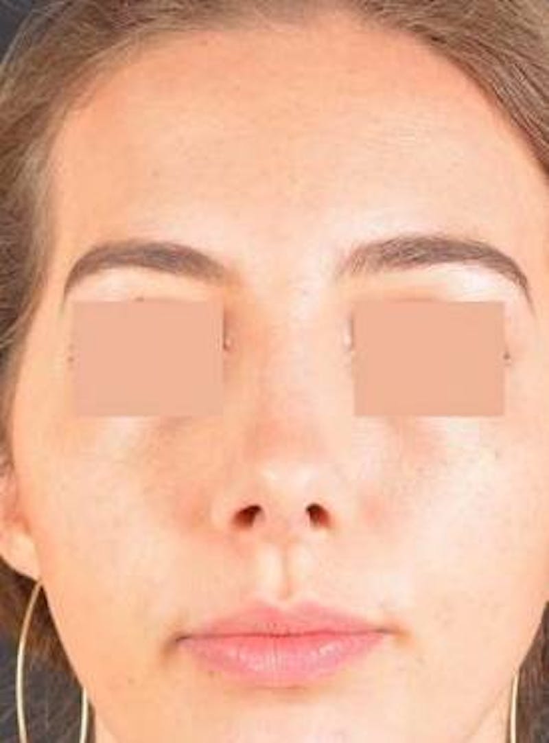 Rhinoplasty Before & After Gallery - Patient 338088 - Image 2