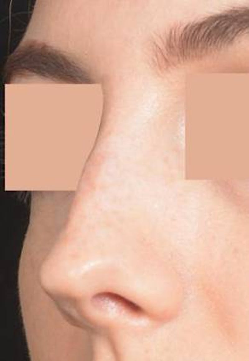 Rhinoplasty Before & After Gallery - Patient 338088 - Image 5