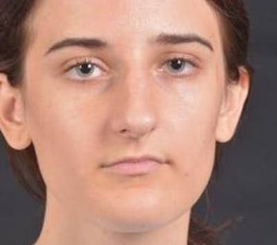 Rhinoplasty Before & After Gallery - Patient 189233 - Image 1