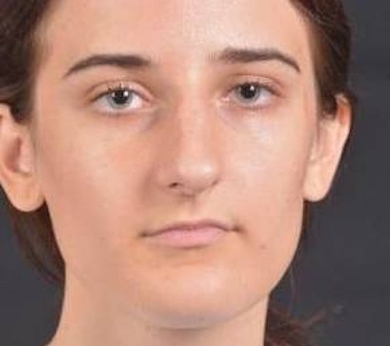 Rhinoplasty Before & After Gallery - Patient 189233 - Image 1