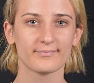 Rhinoplasty Before & After Gallery - Patient 189233 - Image 2