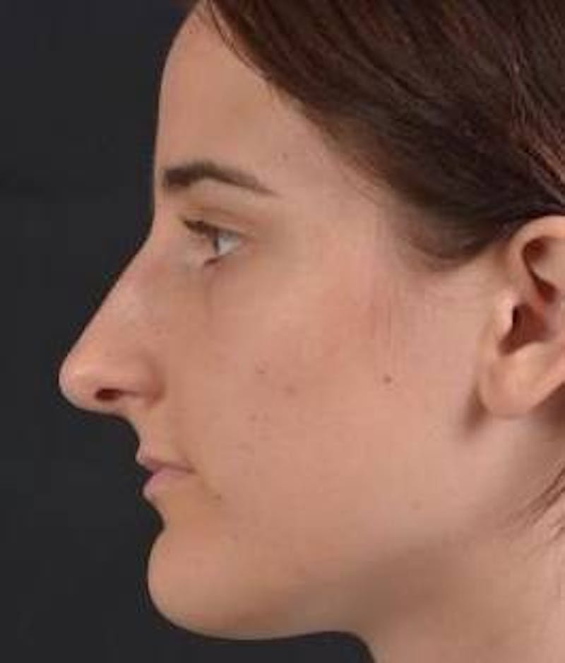 Rhinoplasty Before & After Gallery - Patient 189233 - Image 3