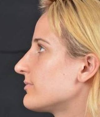 Rhinoplasty Before & After Gallery - Patient 189233 - Image 4