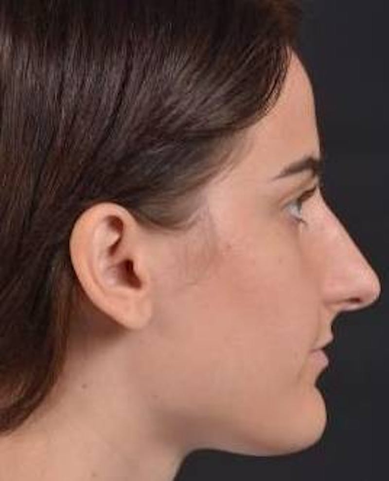 Rhinoplasty Before & After Gallery - Patient 189233 - Image 5