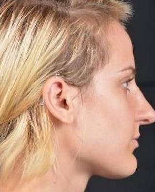 Rhinoplasty Before & After Gallery - Patient 189233 - Image 6