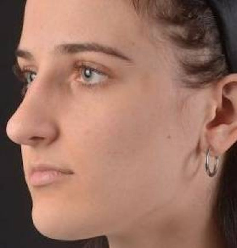 Rhinoplasty Before & After Gallery - Patient 189233 - Image 7