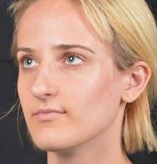 Rhinoplasty Before & After Gallery - Patient 189233 - Image 8