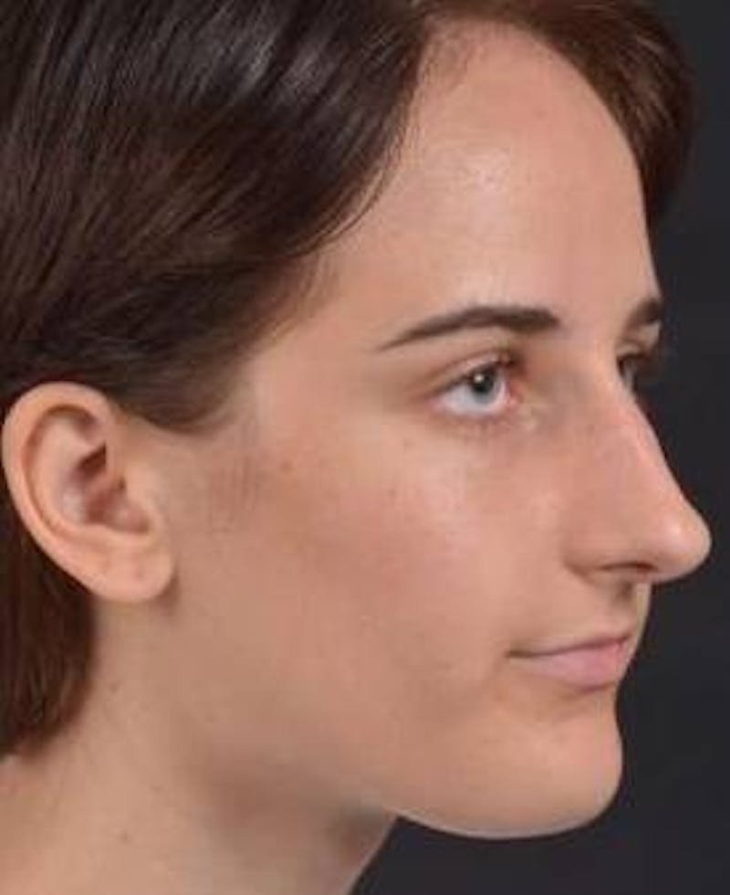 Rhinoplasty Before & After Gallery - Patient 189233 - Image 9
