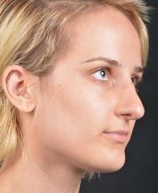 Rhinoplasty Before & After Gallery - Patient 189233 - Image 10