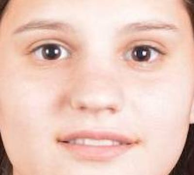 Rhinoplasty Before & After Gallery - Patient 378269 - Image 1