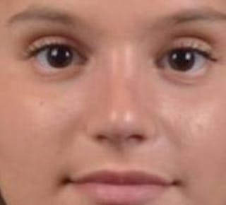 Rhinoplasty Before & After Gallery - Patient 378269 - Image 2