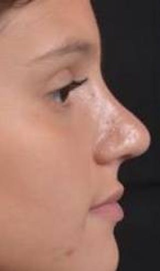Rhinoplasty Before & After Gallery - Patient 378269 - Image 6