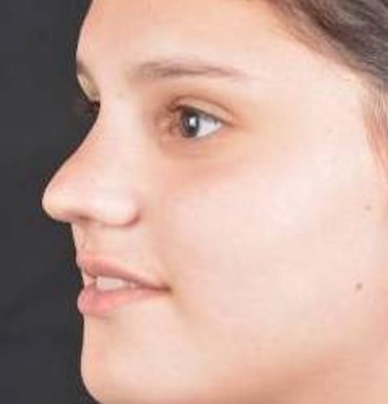 Rhinoplasty Before & After Gallery - Patient 378269 - Image 7