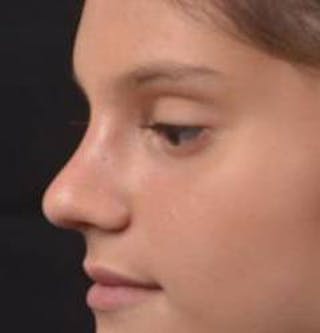 Rhinoplasty Before & After Gallery - Patient 378269 - Image 8