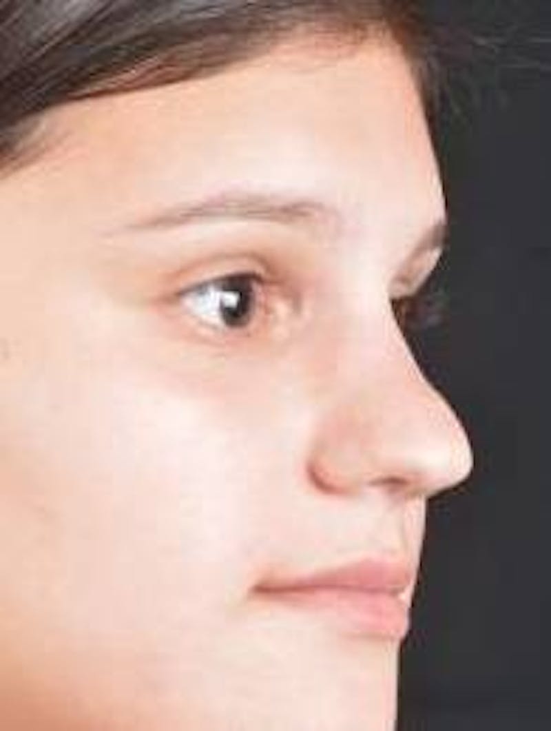 Rhinoplasty Before & After Gallery - Patient 378269 - Image 9