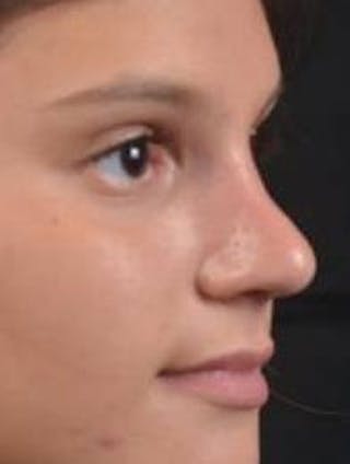 Rhinoplasty Before & After Gallery - Patient 378269 - Image 10