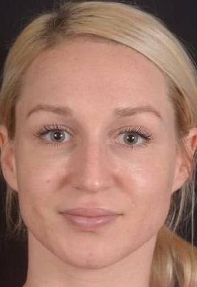 Rhinoplasty Before & After Gallery - Patient 186387 - Image 1