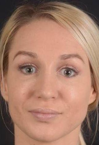 Rhinoplasty Before & After Gallery - Patient 186387 - Image 2