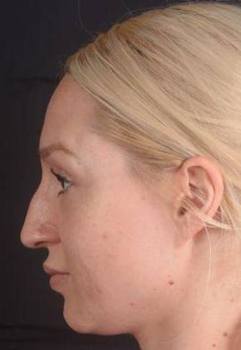 Rhinoplasty Before & After Gallery - Patient 186387 - Image 3