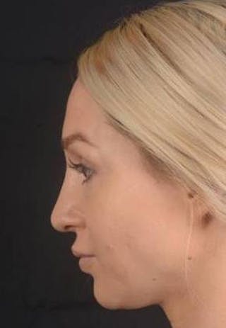 Rhinoplasty Before & After Gallery - Patient 186387 - Image 4