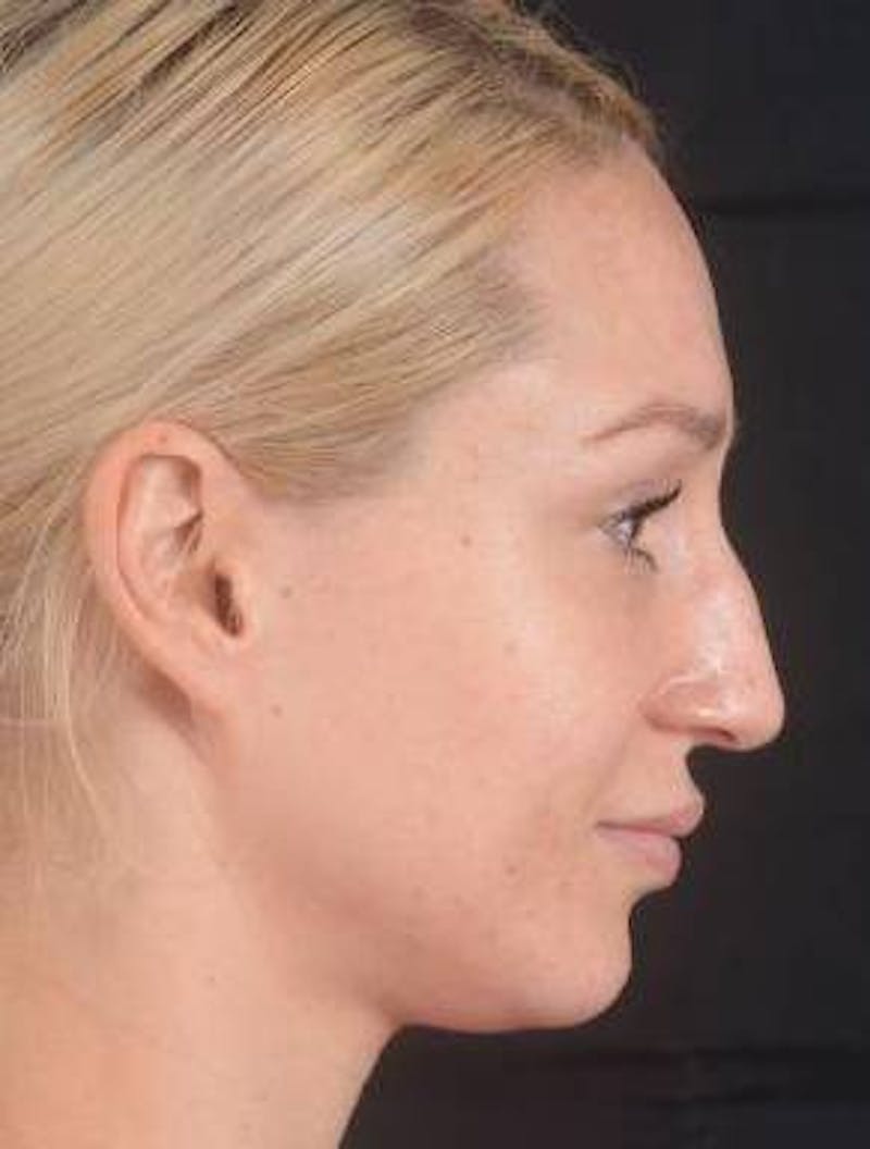 Rhinoplasty Before & After Gallery - Patient 186387 - Image 5