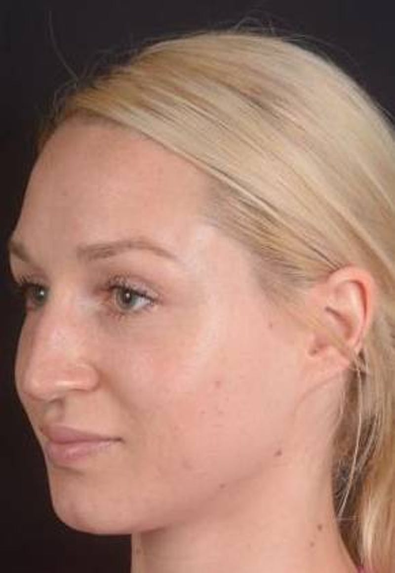 Rhinoplasty Before & After Gallery - Patient 186387 - Image 7