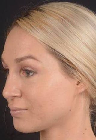 Rhinoplasty Before & After Gallery - Patient 186387 - Image 8