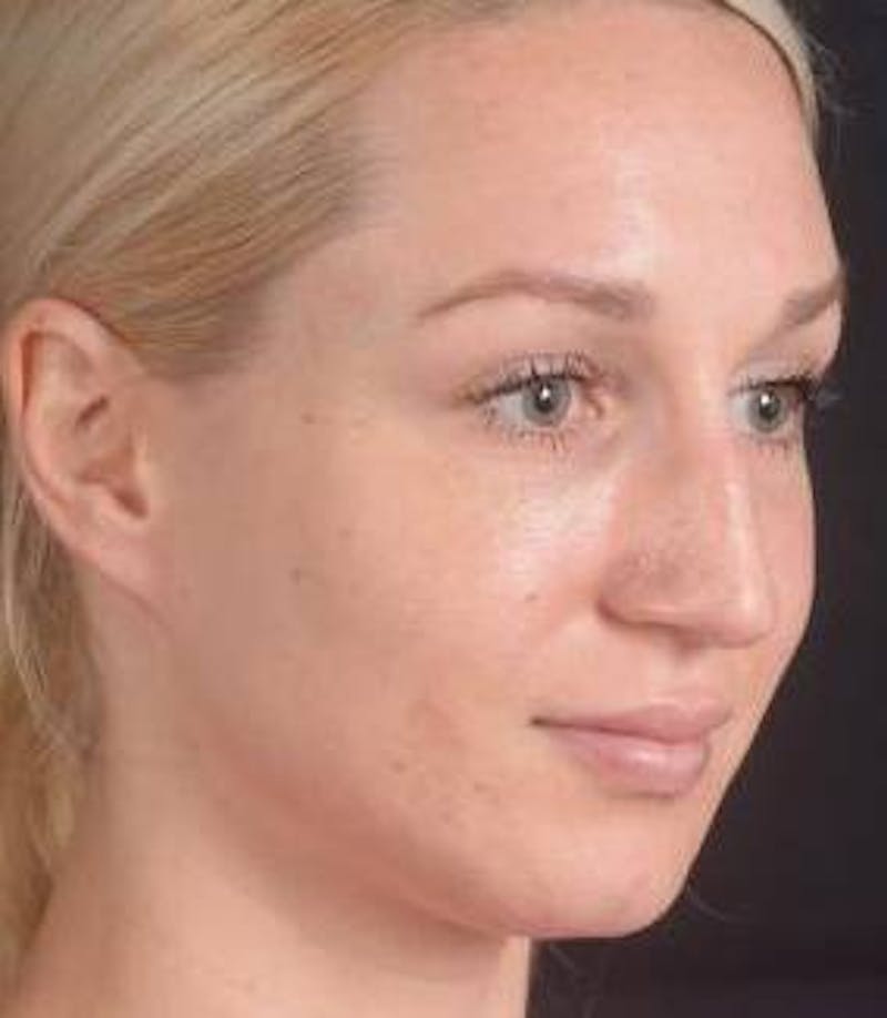 Rhinoplasty Before & After Gallery - Patient 186387 - Image 9