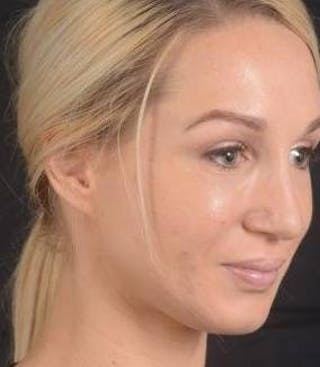 Rhinoplasty Before & After Gallery - Patient 186387 - Image 10