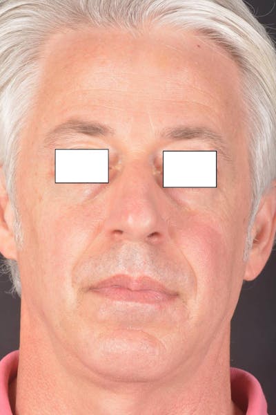 Rhinoplasty Before & After Gallery - Patient 135298 - Image 1
