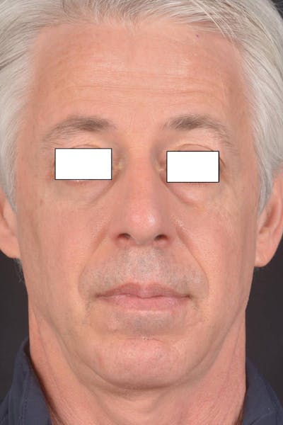 Rhinoplasty Before & After Gallery - Patient 135298 - Image 2