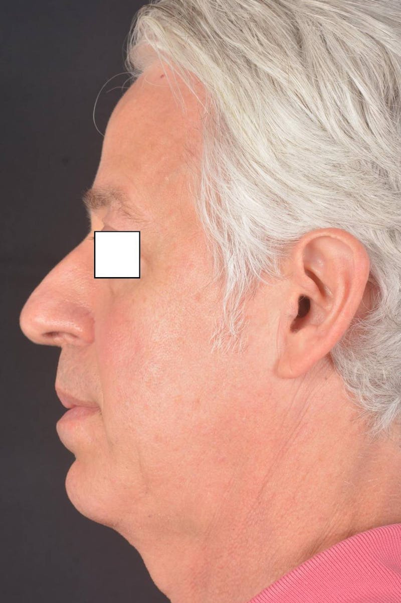 Rhinoplasty Before & After Gallery - Patient 135298 - Image 3