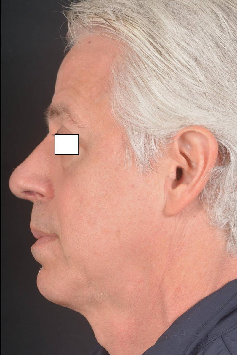 Rhinoplasty Before & After Gallery - Patient 135298 - Image 4