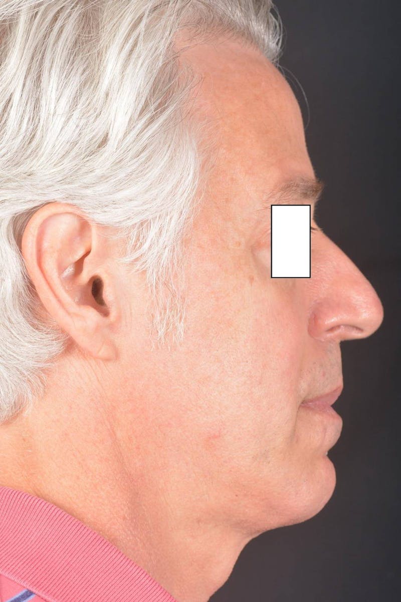 Rhinoplasty Before & After Gallery - Patient 135298 - Image 5